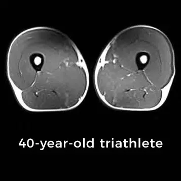 an x-ray of the healthy body of a 40-year-old triathletes healthy thighs.