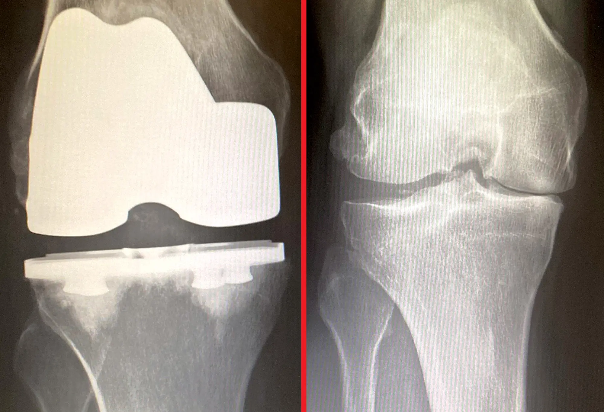 After and before X-rays of the author's knee. One is a solid titanium implant and the other shows reduced joint space from worn out cartilage and bone spurs. A knee of that condition is the result of injuries and years of hard use.